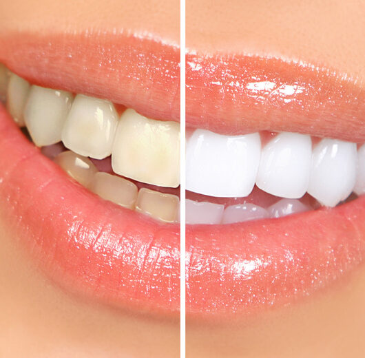 Zoom Teeth Whitening - Registered Professional - Derby City Centre | Wowcher